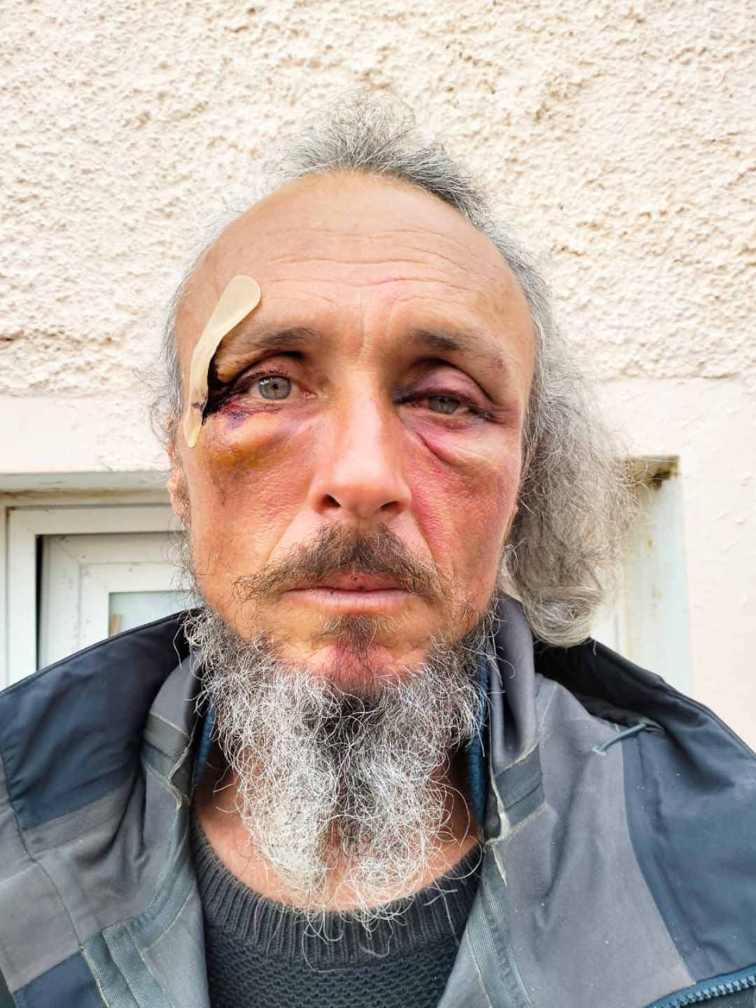 Thumbnail preview image for the video titled: A Global Sumud activist shows evidence of torture inflicted by Israeli soldiers on his body