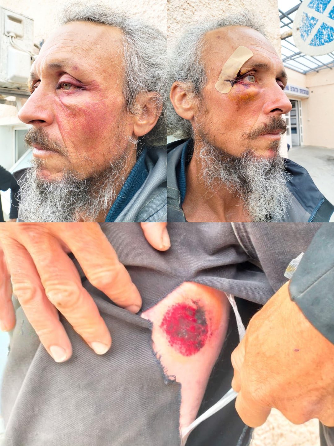 Thumbnail preview image for the video titled: A Global Sumud activist shows evidence of torture inflicted by Israeli soldiers on his body