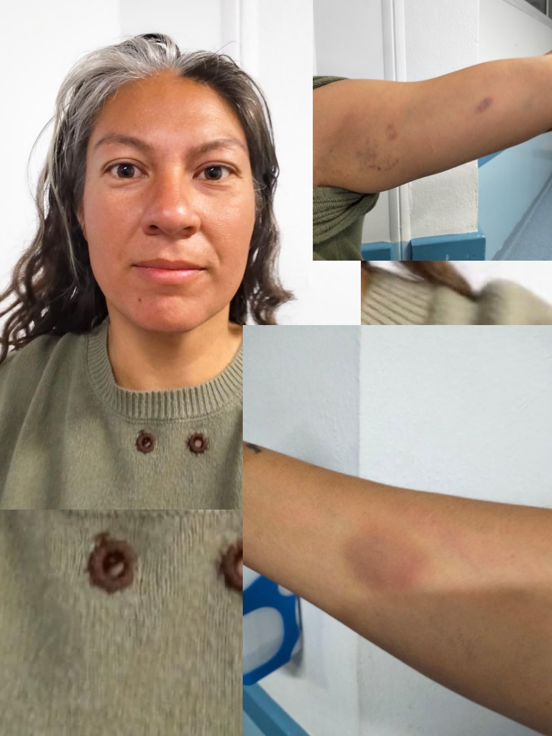 Thumbnail preview image for the video titled: A Global Sumud activist shows evidence of torture inflicted by Israeli soldiers on his body