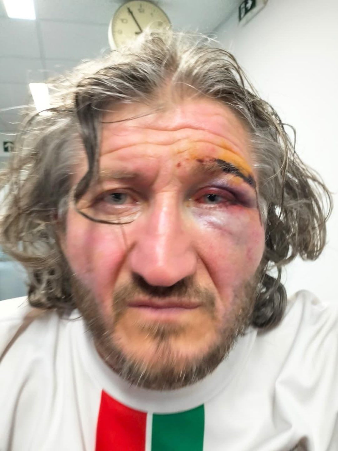Thumbnail preview image for the video titled: A Global Sumud activist shows evidence of torture inflicted by Israeli soldiers on his body