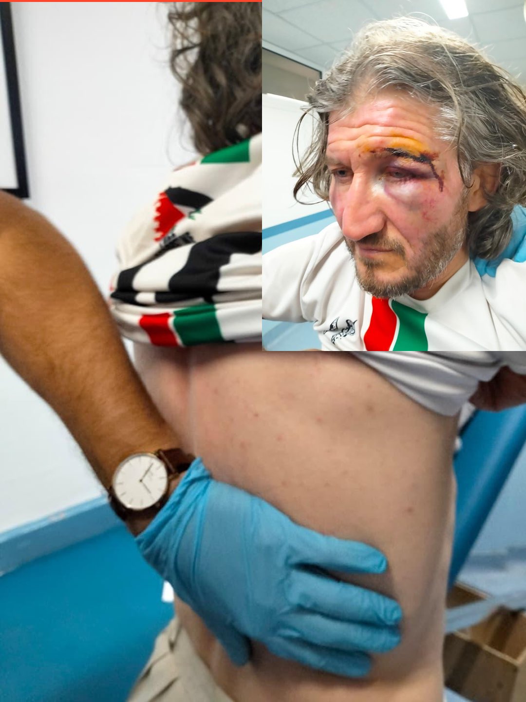 Thumbnail preview image for the video titled: A Global Sumud activist shows evidence of torture inflicted by Israeli soldiers on his body