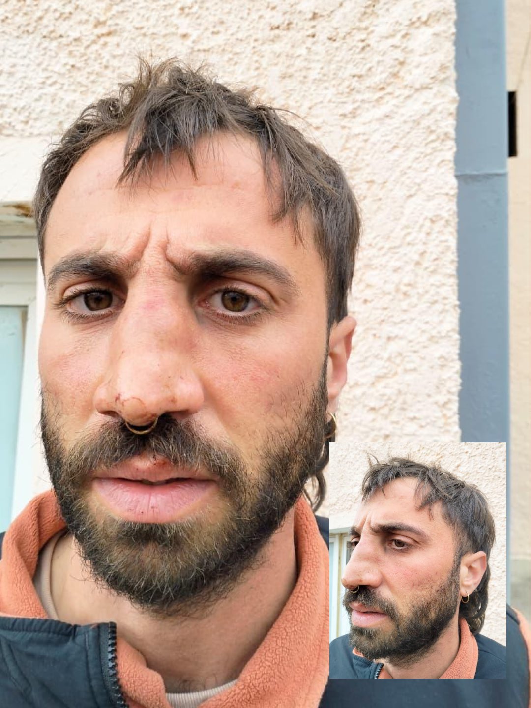 Thumbnail preview image for the video titled: A Global Sumud Flotilla activist shows evidence of torture inflicted by Israeli soldiers on his body