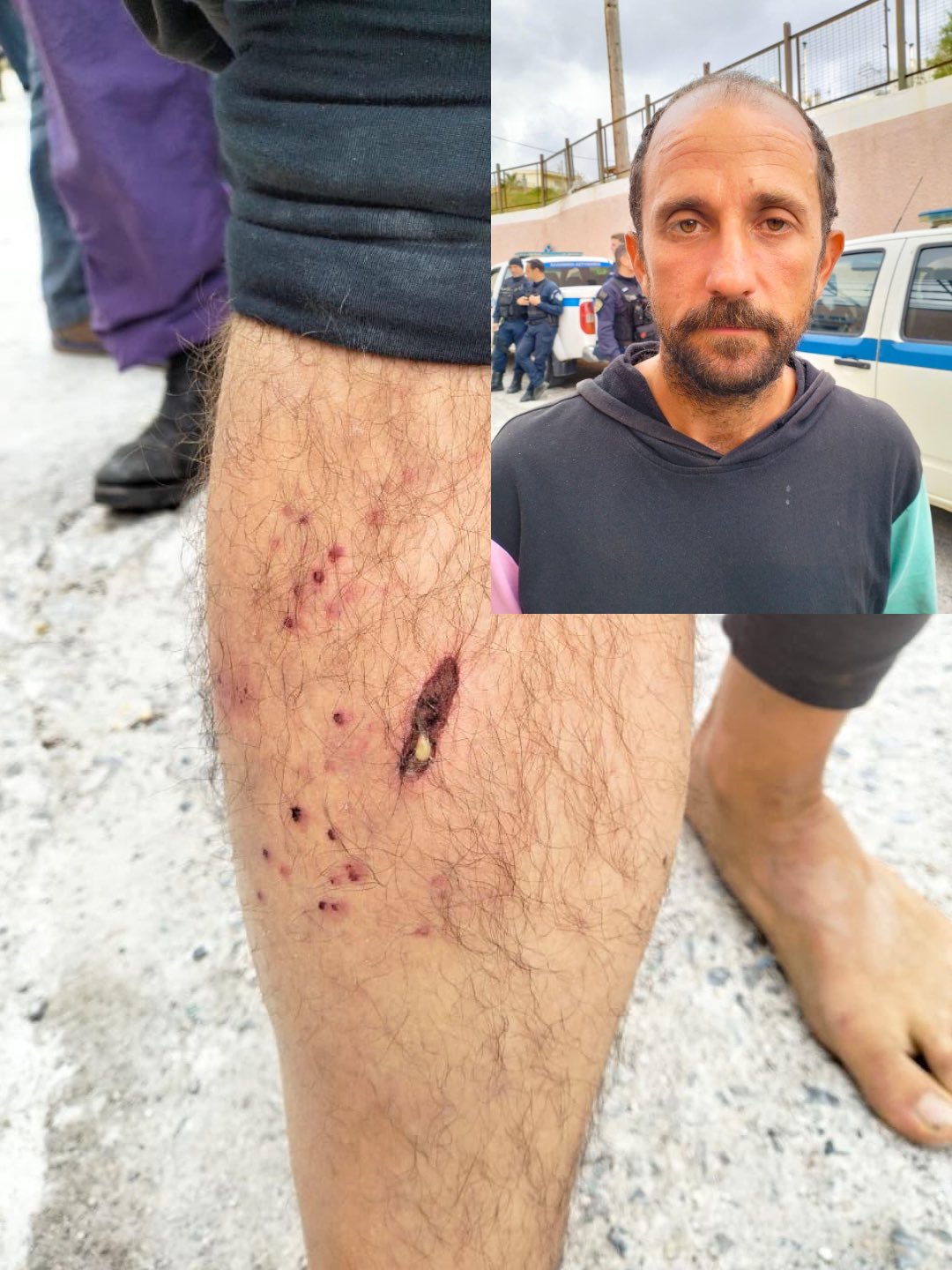 Thumbnail preview image for the video titled: A Global Sumud Activist shows evidence of torture inflicted by Israeli soldiers on his body