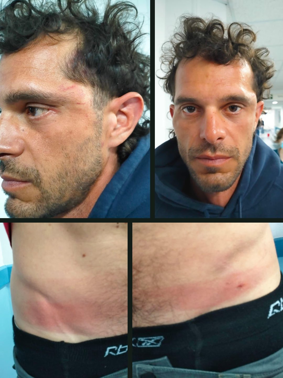 Thumbnail preview image for the video titled: A Sumud Flotitta activist shows evidence of torture inflicted by Israeli soldiers on his body