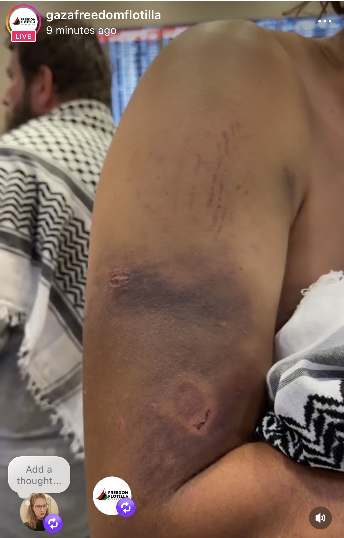 Thumbnail preview image for the video titled: A Global Sumud activist shows evidence of torture inflicted by Israeli soldiers on his body