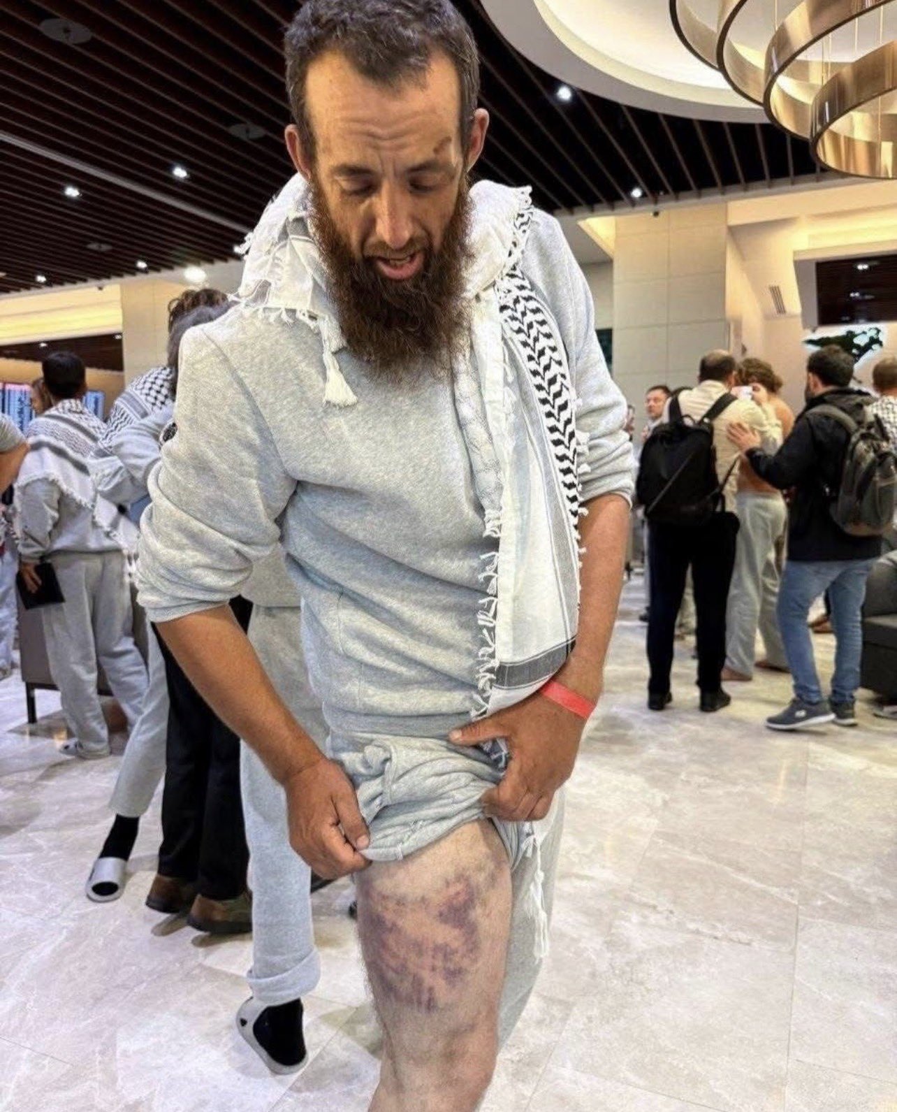 Thumbnail preview image for the video titled: A Global Sumud activist shows evidence of torture inflicted by Israeli soldiers on his body