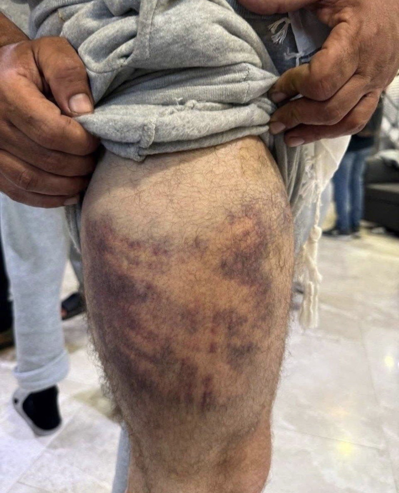Thumbnail preview image for the video titled: A Global Sumud activist shows evidence of torture inflicted by Israeli soldiers on his body