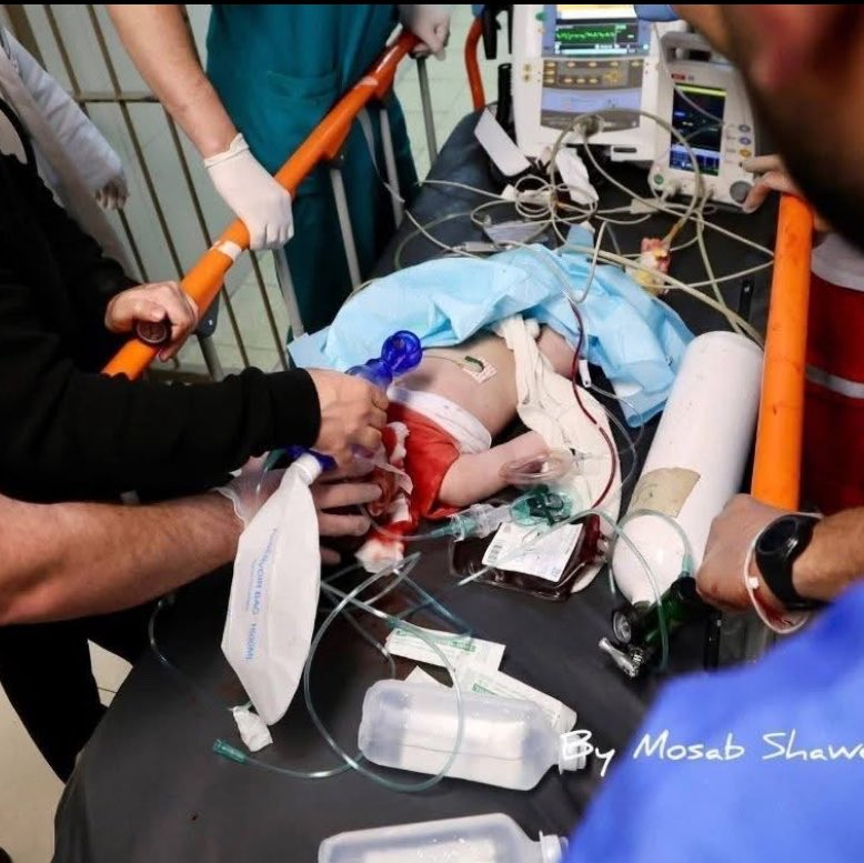 Thumbnail preview image for the video titled: 7-month-old Sam Fahd Abu Haikal receiving emergency treatment before passing away