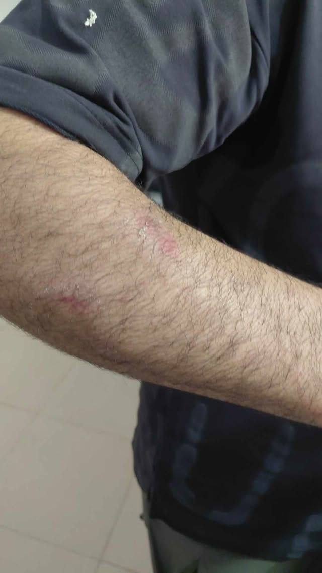 Thumbnail preview image for the video titled: A Palestinian man injured during the pogrom carried out by Israeli settlers and soldiers in Huwara