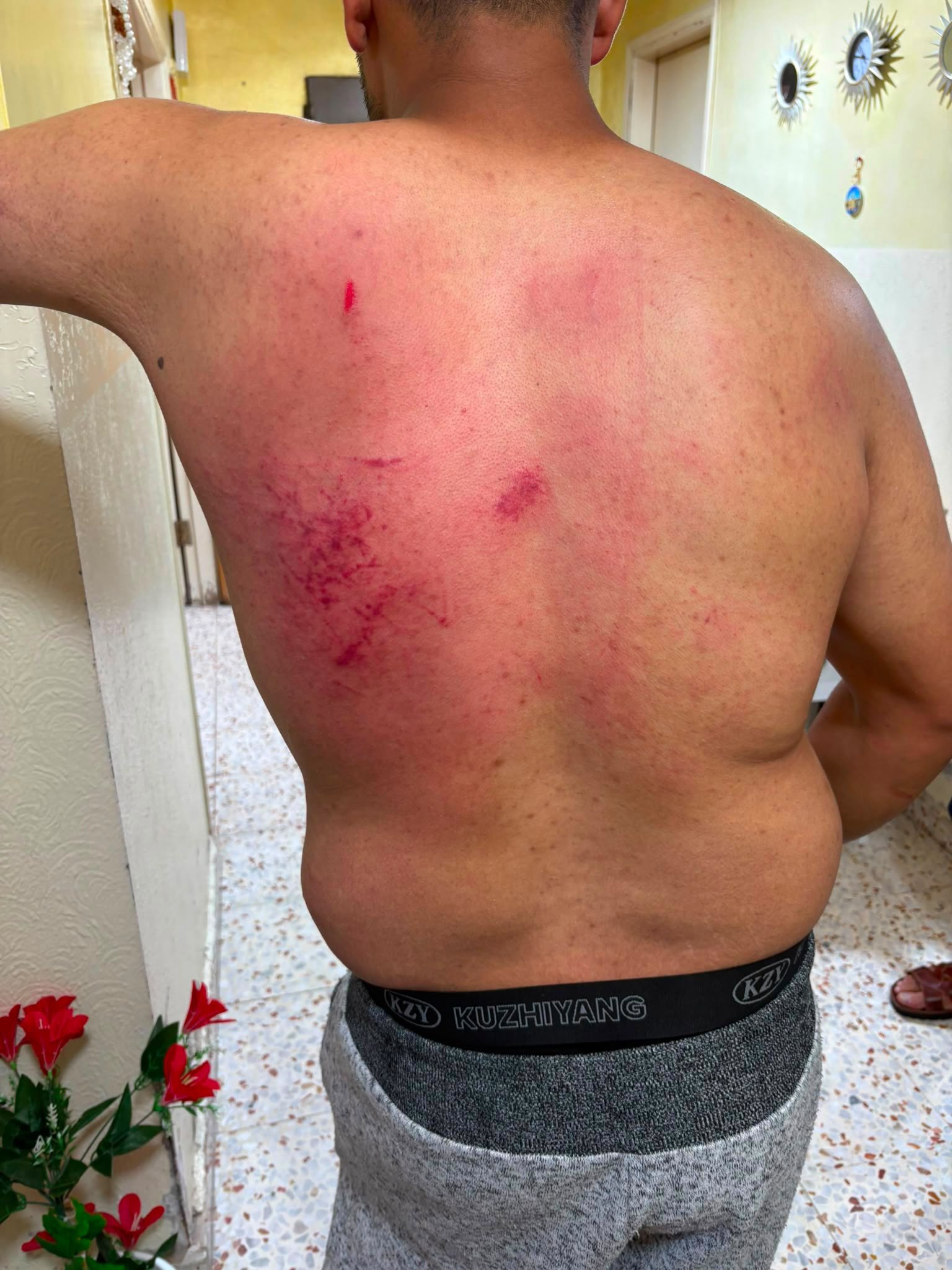 Thumbnail preview image for the video titled: Back of a man severely beaten during the Israeli military operation in Qalandiya and Kafr Aqab