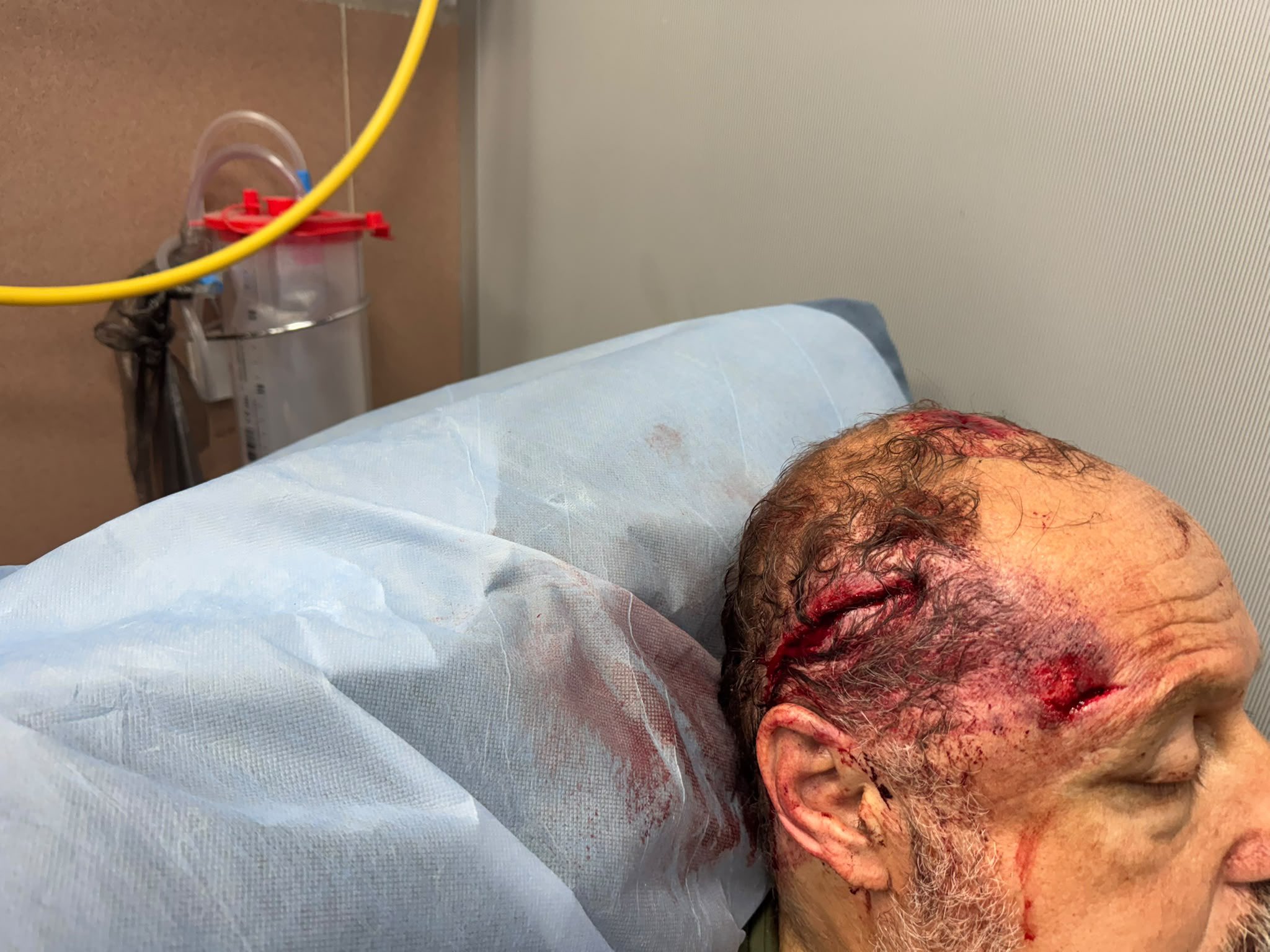 Thumbnail preview image for the video titled: A Palestinian-American citizen, Haytham Taysir, almost killed by settlers in his olive groves in Burqa