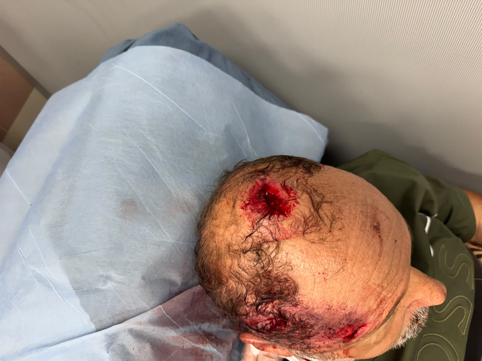 Thumbnail preview image for the video titled: A Palestinian-American citizen, Haytham Taysir, almost killed by settlers in his olive groves in Burqa