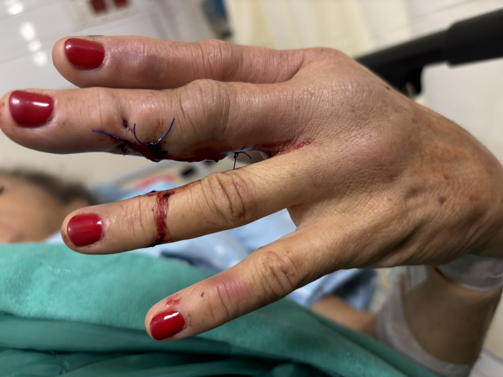 Thumbnail preview image for the video titled: Journalist Heidi Levine severely injured by Israeli settlers in Abu Falah while covering the olive harvest