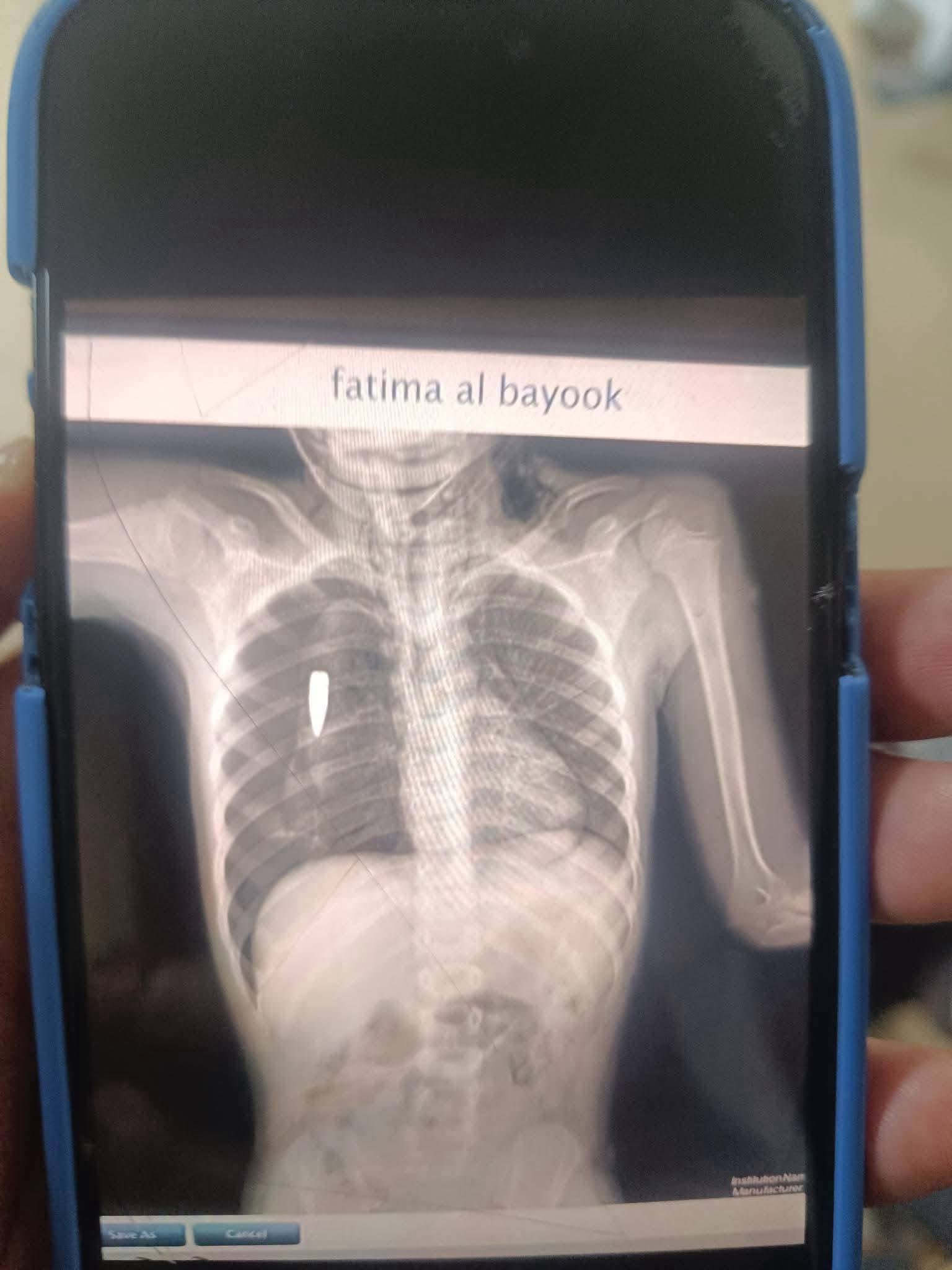 Thumbnail preview image for the video titled: X-ray shows Israeli bullet lodged in the chest of child Fatima Al-Bayouk