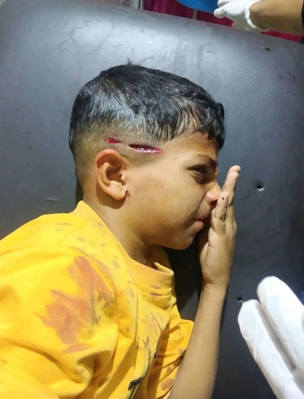 Thumbnail preview image for the video titled: Child with a bullet graze wound to the head from Israeli gunfire